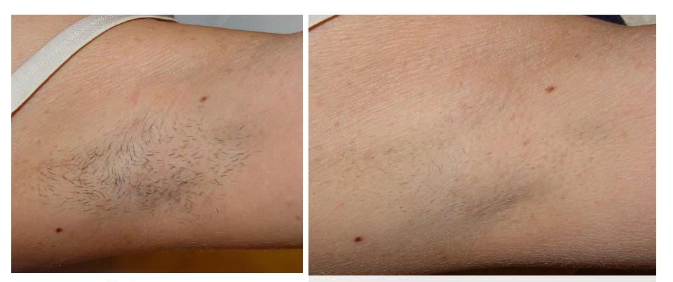 Hair removal1